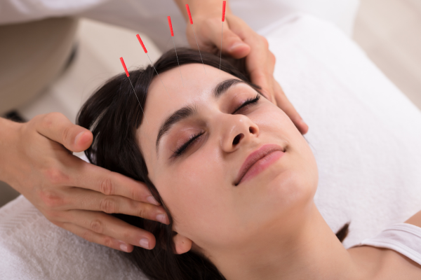 Discover the Benefits of Acupuncture: Woman Receiving Treatment