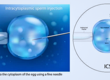 An illustration showing the intracytoplasmic sperm injection procedure, a key step in IVF and artificial insemination.