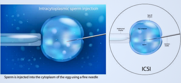 An illustration showing the intracytoplasmic sperm injection procedure, a key step in IVF and artificial insemination.